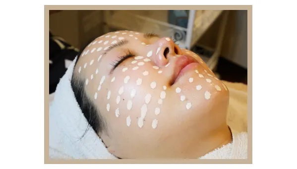 メソスキンカラー受けている写真