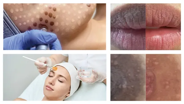 メソスキンカラーセット内容