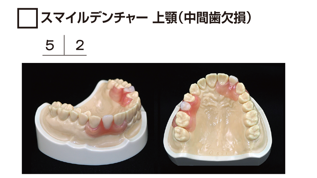 ｻﾝﾌﾟﾙ　ｽﾏｲﾙﾃﾞﾝﾁｬｰ上顎　中間歯欠損